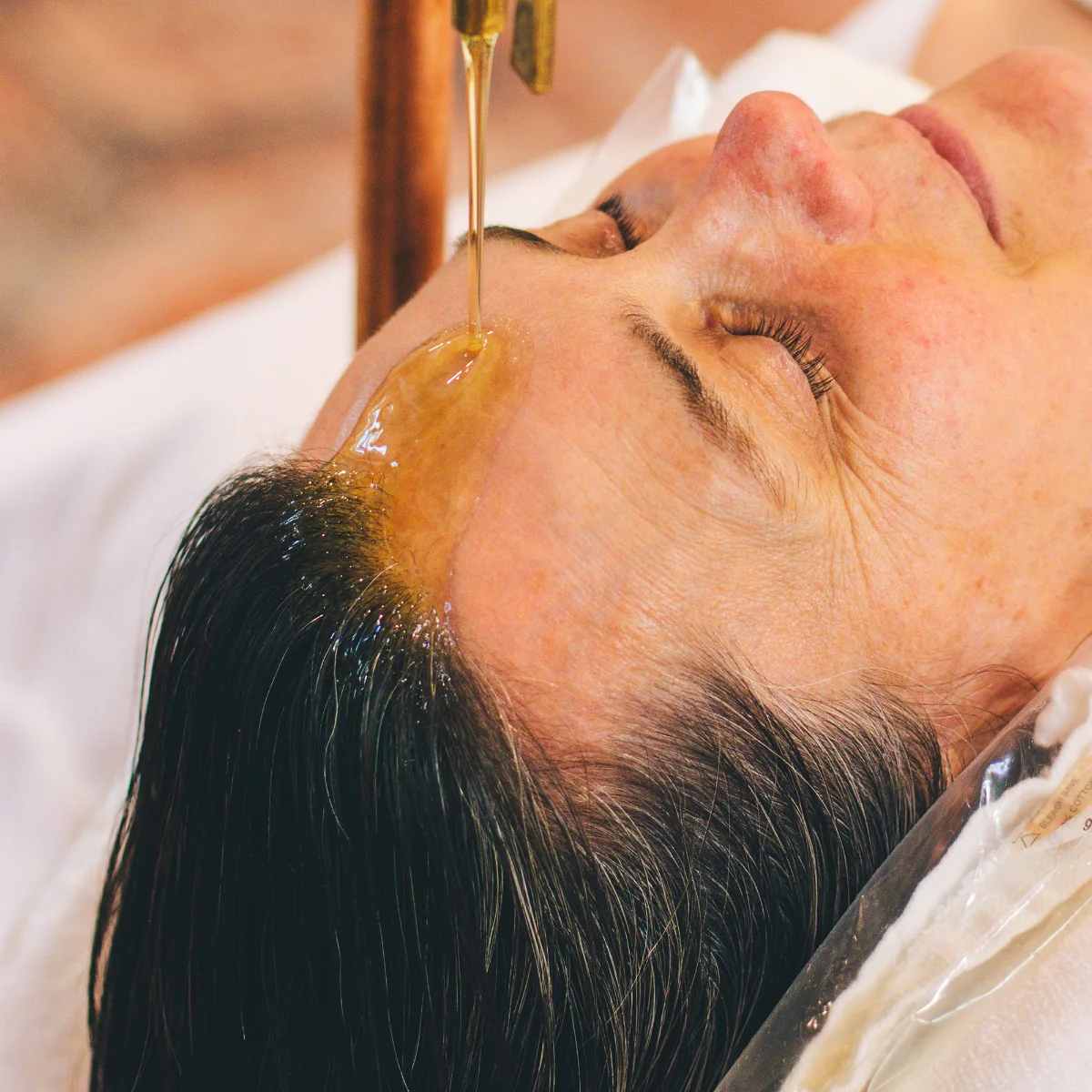 Shirodhara for Migraine & Insomnia: How This Ancient Therapy Calms Your Mind
