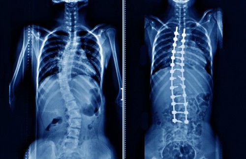 Can Slip Disc Heal Without Surgery? The Ayurvedic Answer